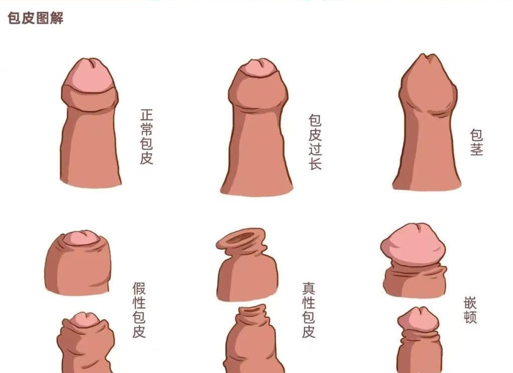 割包皮真的能让时间更持久、更爽,鸡鸡变长吗3 20261010171825752-bd425a0ade2fdadfb31333fdab440941