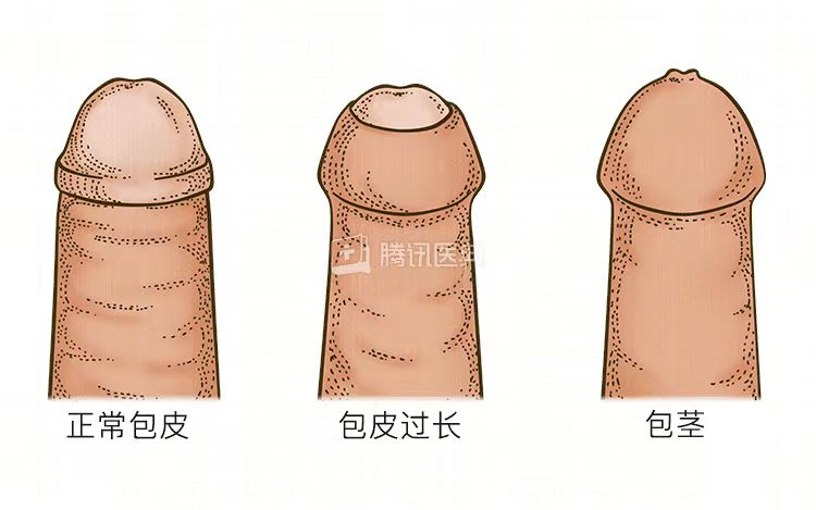 割包皮真的能让时间更持久、更爽,鸡鸡变长吗2 20261010171904577-ba83c0b3e8962c2e005403ccf4a37087